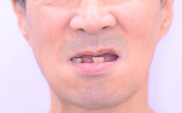 치료 전 - 앞니 결손으로 인한 저작 불편