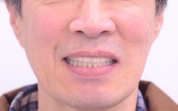 치료 후 - 임플란트로 회복된 자연스러운 미소