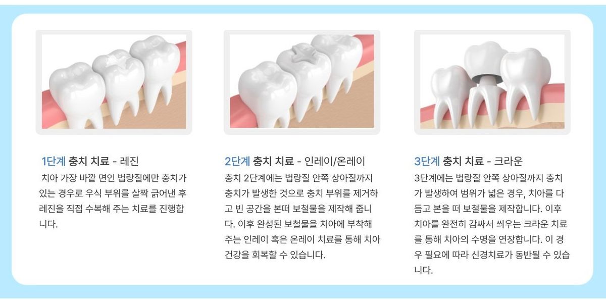 충치 진행 단계별 치료 방법: 1단계 레진, 2단계 인레이/온레이, 3단계 크라운