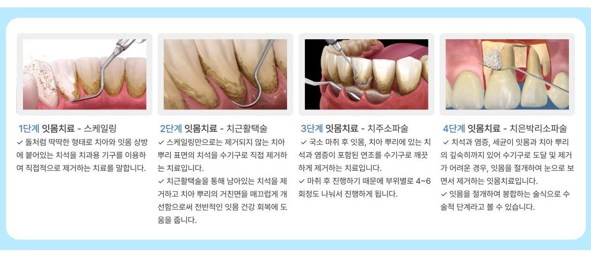 잇몸치료 진행 단계별 치료: 1단계 스케일링, 2단계 치근활택술, 3단계 치주소파술, 4단계 치은박리소파술