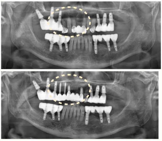 좁은 골폭 임플란트 케이스 — Before & After X-ray