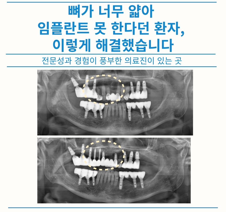 뼈가 너무 얇아 임플란트 못한다던 환자, 이렇게 해결했습니다 — 치료 전후 X-ray 비교