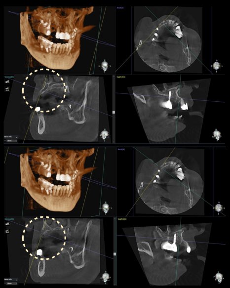 환자 초기 상태 — CBCT 검사 결과