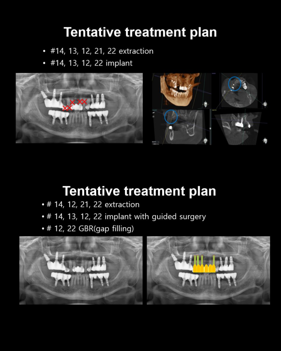 Tentative treatment plan — 발치 부위와 임플란트 식립 계획