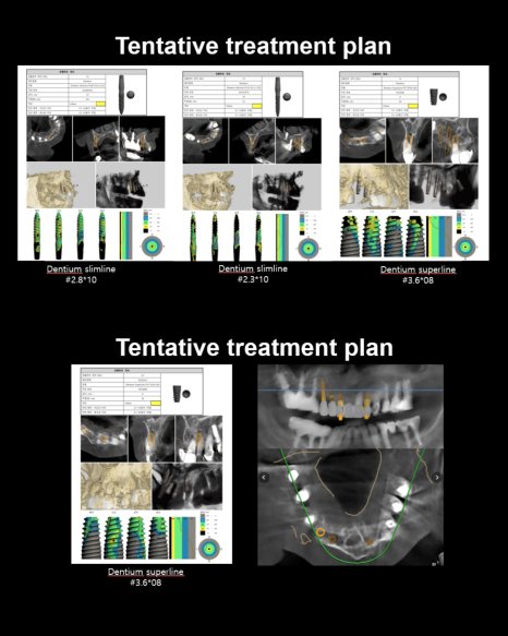 Tentative treatment plan — Dentium slimline & superline 임플란트 선택