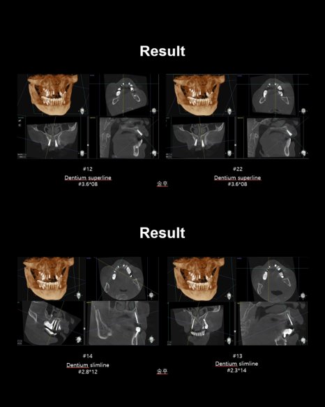 Result — CBCT 상에서 임플란트 식립 후 골 밀착도 확인