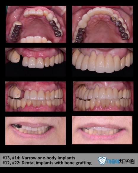 #13, #14 Narrow one-body implants / #12, #22 Dental implants with bone grafting — 최종 결과