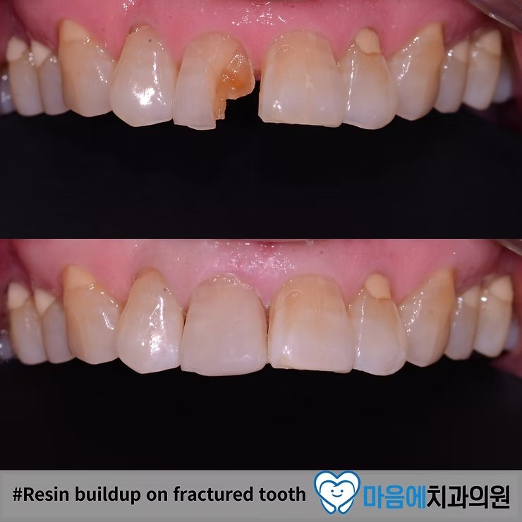 파절치 레진치료 과정 — 연구모델 제작 + 색상 차트 + 빌드업 단계