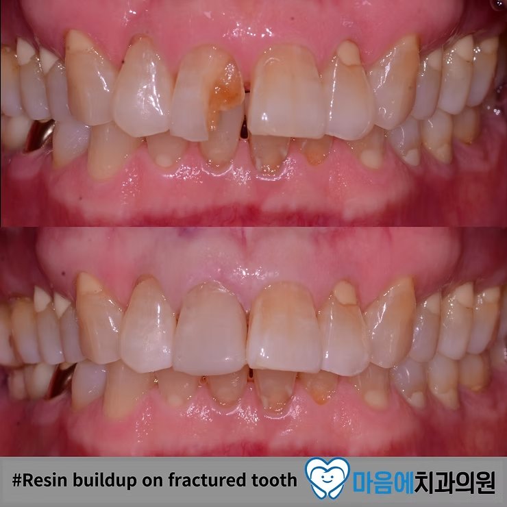 #Resin buildup on fractured tooth — 치료 전후 비교