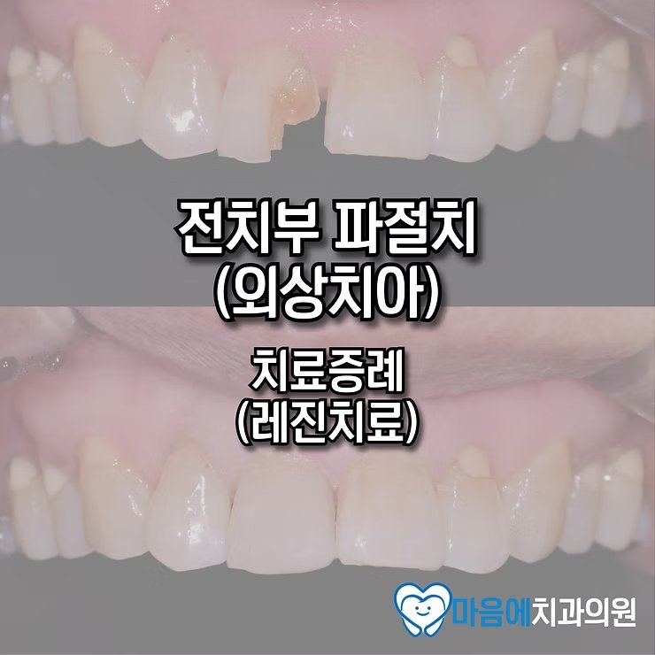 활짝 웃는 모습의 최종 결과 — Resin buildup on fractured tooth