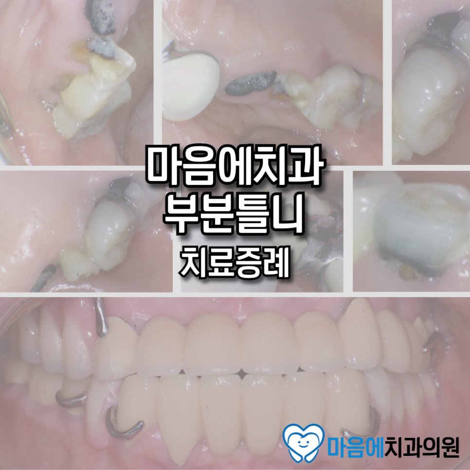 마음에치과 부분틀니 치료증례 — Before & After