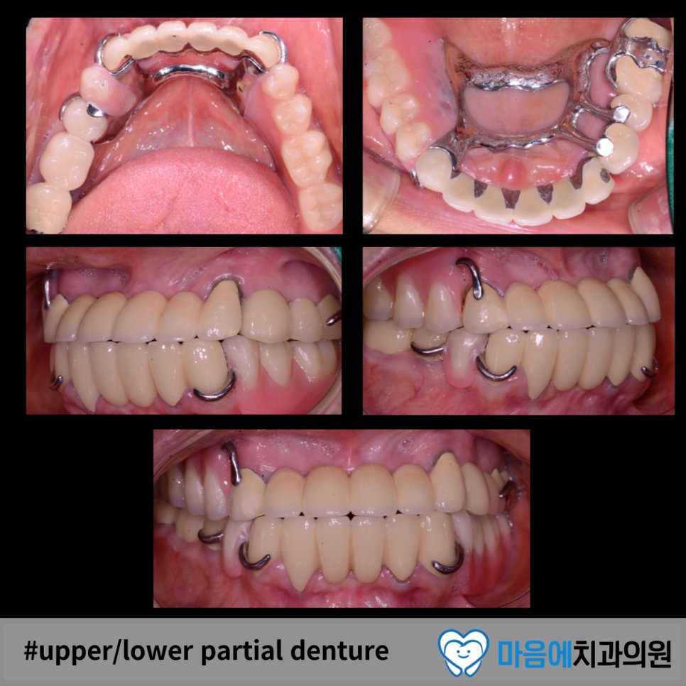 #upper/lower partial denture — 최종 결과