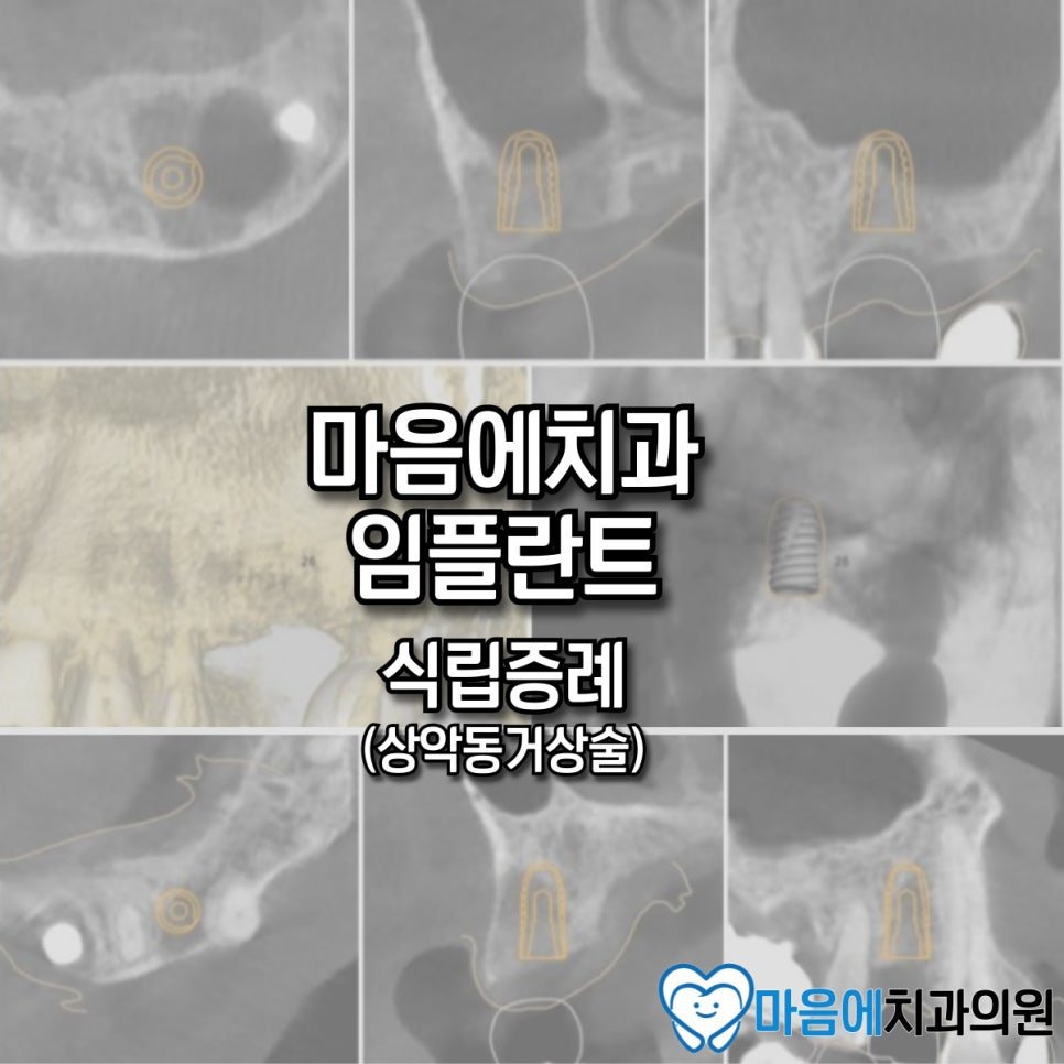 마음에치과 임플란트 식립증례 — 상악동거상술