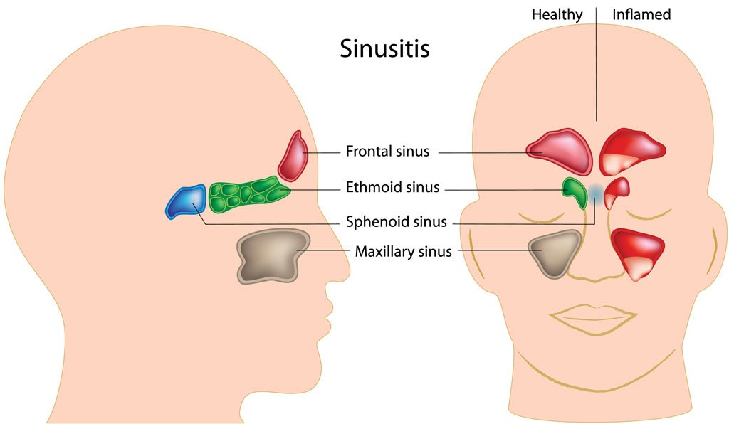 Sinusitis 해부도 — Frontal, Ethmoid, Sphenoid, Maxillary sinus