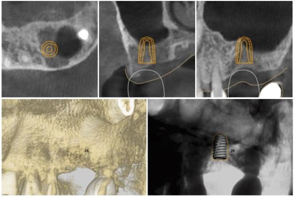 CBCT 식립 계획 — 상악동 거상 부위 #26