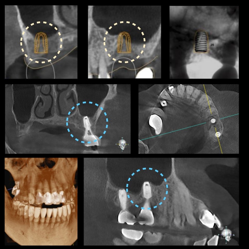 6개월 후 CBCT — 임플란트 주변 골 생성 확인
