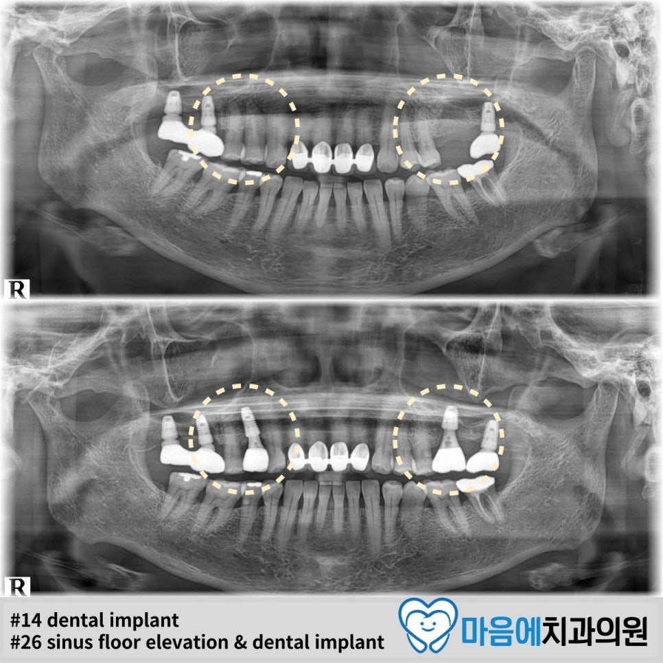 #14 dental implant + #26 sinus floor elevation & dental implant — 파노라마 Before/After