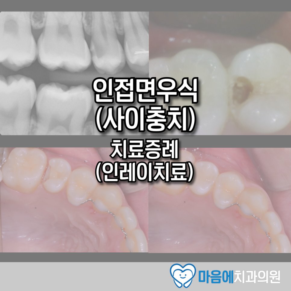 인접면우식(사이충치) 치료증례 — 인레이치료