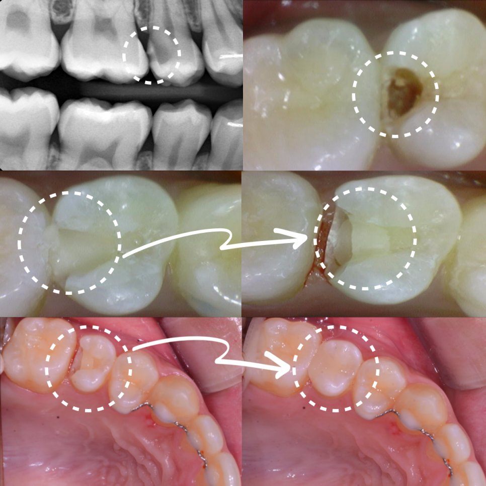 인접면 충치 — X-ray, 충치 부위, 제거 후, 인레이 보철 전후 비교