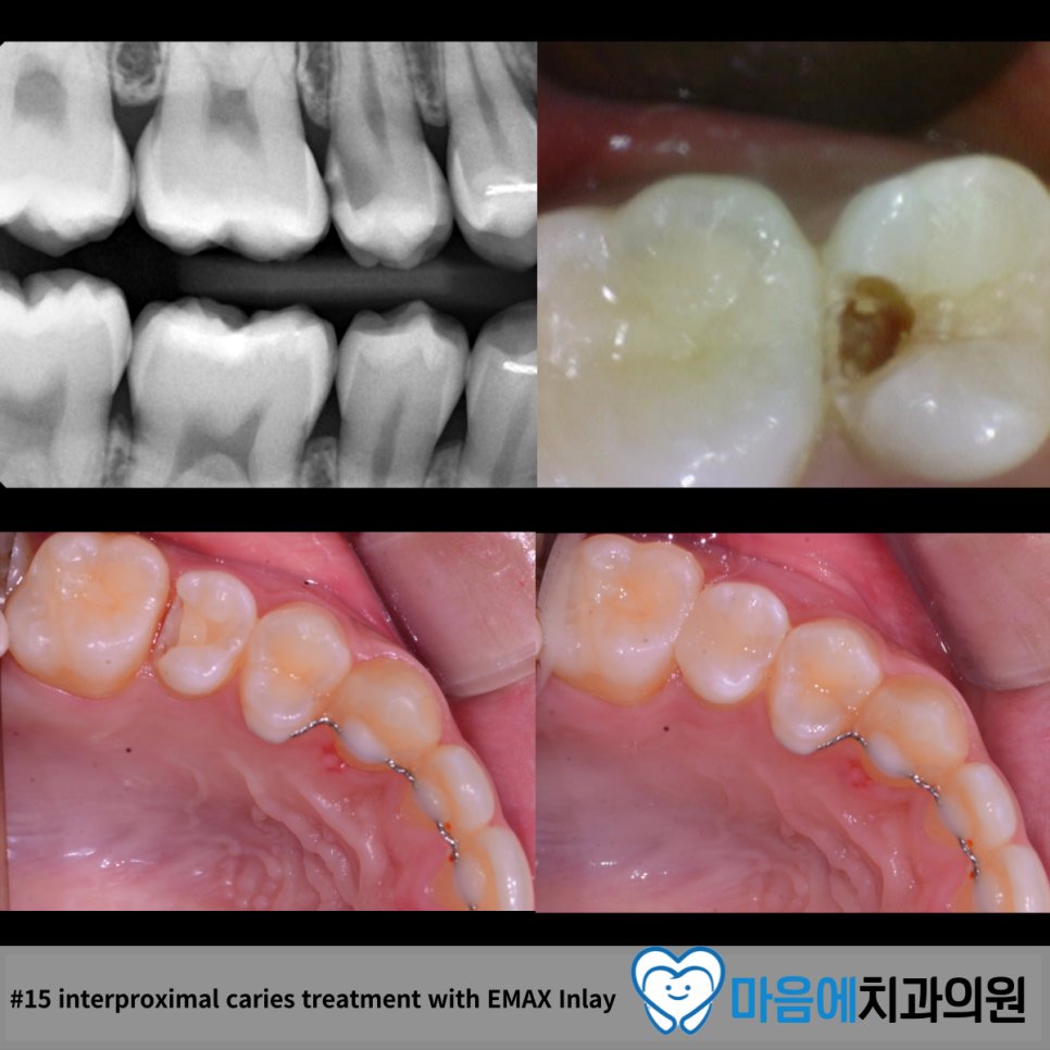 #15 interproximal caries treatment with EMAX Inlay — 최종 결과