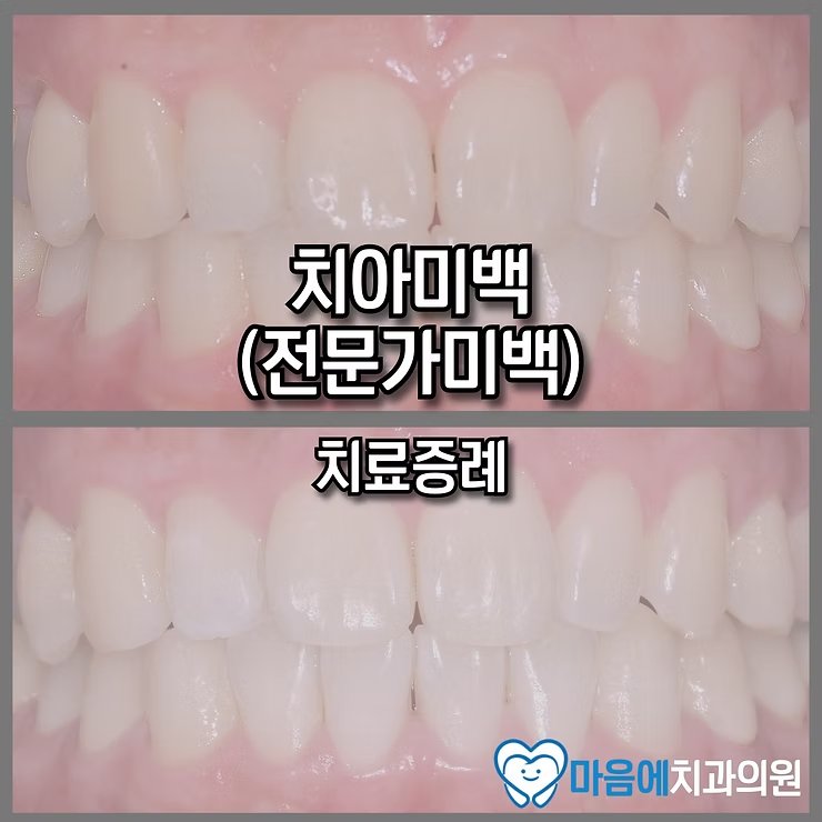 치아미백 (전문가미백) 치료증례 — Before & After