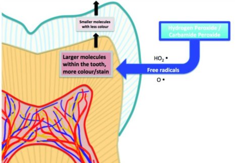 치아 미백 원리 — Hydrogen Peroxide / Carbamide Peroxide가 색소 분자를 쪼개는 메커니즘