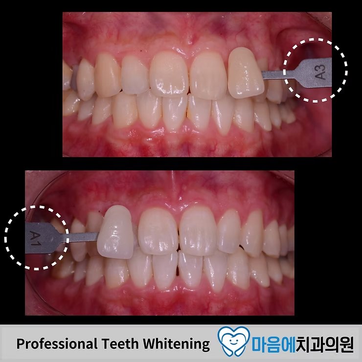 Professional Teeth Whitening — Before A3 / After A1, 두 단계 밝아진 결과