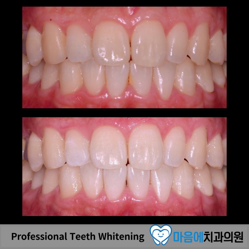 Professional Teeth Whitening — 치료 전후 정면 비교