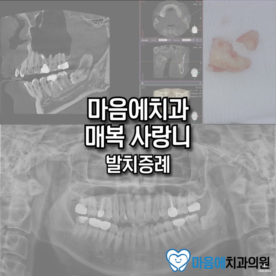 마음에치과 매복 사랑니 발치증례 — Before & After
