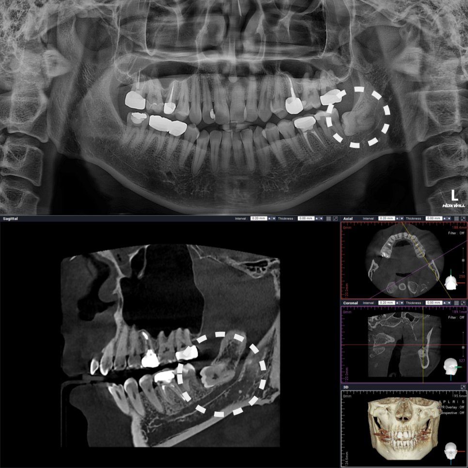 매복 사랑니 X-ray와 CBCT — 신경에 닿아있는 누운 사랑니