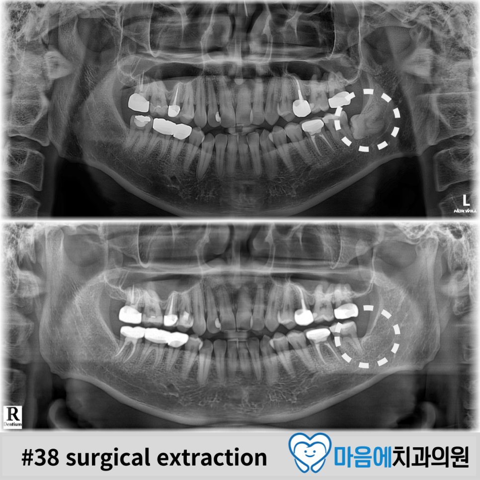 #38 surgical extraction — 발치 전후 파노라마 비교