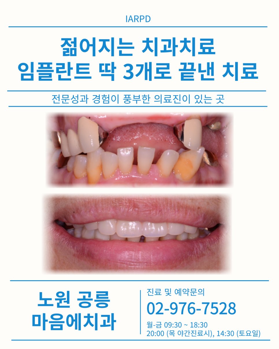 IARPD — 젊어지는 치과치료, 임플란트 딱 3개로 끝낸 치료