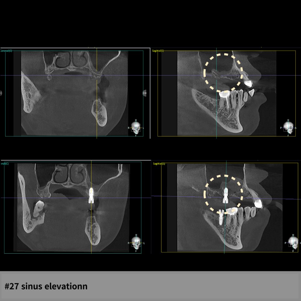 #27 sinus elevation CBCT — 상악동 막 거상 전후 비교