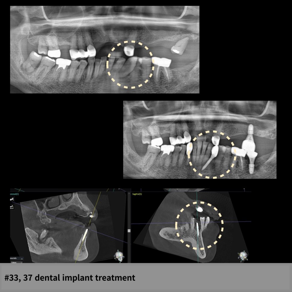 #33, 37 dental implant treatment — X-ray와 CBCT