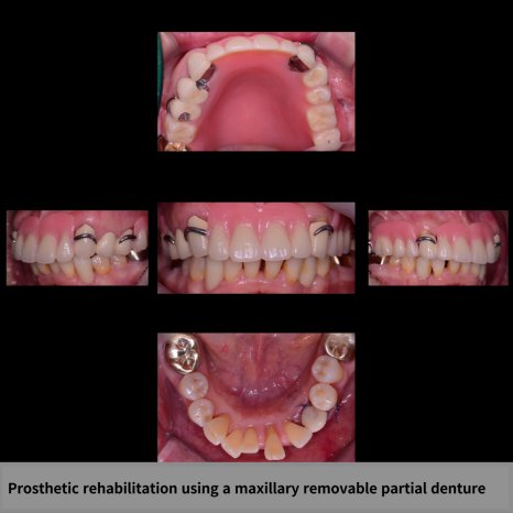 Prosthetic rehabilitation using a maxillary removable partial denture