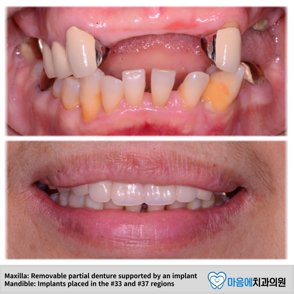 치료 전후 미소 비교 — Maxilla: RPD supported by implant, Mandible: implants at #33, #37